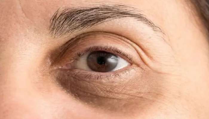 Dark circles: കണ്ണിന് ചുറ്റുമുള്ള കറുത്ത പാട് കുറയ്ക്കാം... വീട്ടിൽ തന്നെയുണ്ട് മാർ​ഗങ്ങൾ