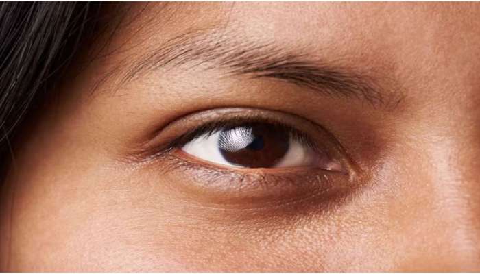 Dark Circles: കണ്ണിന് ചുറ്റുമുള്ള 'ഡാർക്ക് സർക്കിൾസ്' ഇല്ലാതാക്കാം: ഈ പൊടിക്കൈകൾ പരീക്ഷിക്കൂ...!