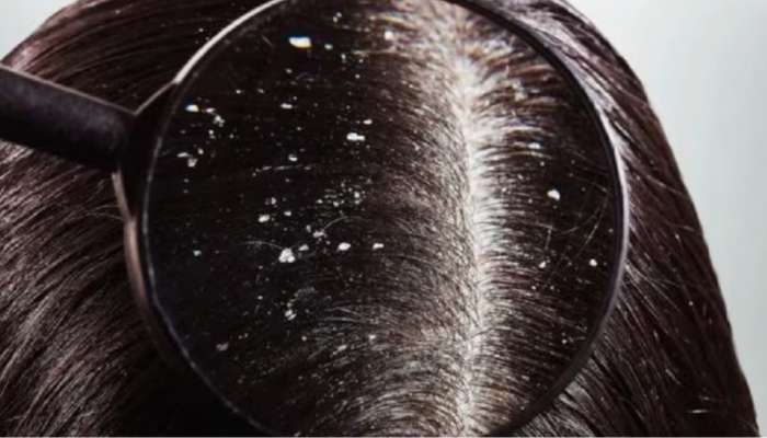 Dandruff: താരൻ അലട്ടുന്നുണ്ടോ? ഈ വീട്ടുവൈദ്യങ്ങളിലുണ്ട് പ്രതിവിധി..!