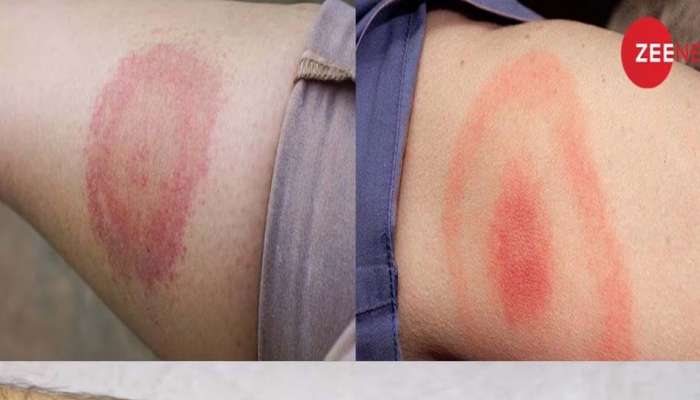 Lyme Disease: കോവിഡ്  JN.1 പ്രതിസന്ധിക്കിടെ ഹിമാചലില്‍ അപൂർവ രോഗം പടരുന്നു, പരിശോധനയ്ക്കായി ചെക്ക് റിപ്പബ്ലിക്കിൽ നിന്ന് കിറ്റ്  