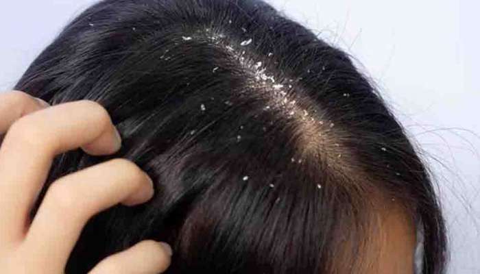 Dandruff Remedies : താരനും മുടി കൊഴിച്ചിലും ചൊറിച്ചിലും അസഹനീയമോ? ഇതാ പ്രതിവധി