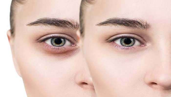 Dark Circles: കൺതടങ്ങളിലെ ഇരുണ്ട നിറം മാറ്റാന്‍ ചില നുറുങ്ങുകള്‍ 