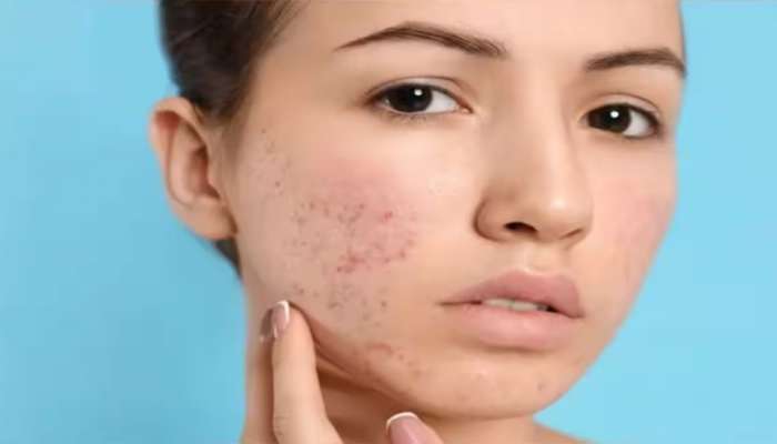 Pimples: മുഖക്കുരു പാടുകളാൽ വിഷമിക്കുന്നുണ്ടോ? ആഴ്ചയിൽ ഒരിക്കൽ ഇങ്ങനെ ചെയ്തു നോക്കൂ