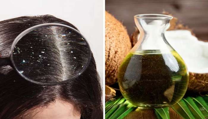 Dandruff Treatment: താരന്‍ മൂലം വിഷമിക്കുന്നോ? ഈ വീട്ടുവൈദ്യങ്ങൾ പരീക്ഷിക്കൂ, എന്നന്നേയ്ക്കുമായി പറയാം ബൈ 