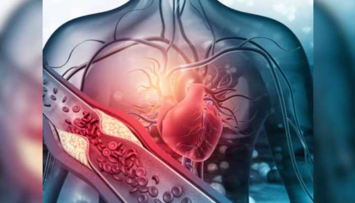 Angioplasty: എന്താണ് ആൻജിയോപ്ലാസ്റ്റി? അറിഞ്ഞിരിക്കേണ്ടതെല്ലാം