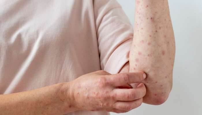 Chickenpox: എന്താണ് ചിക്കൻ പോക്സ്? എങ്ങനെ പകരും..?