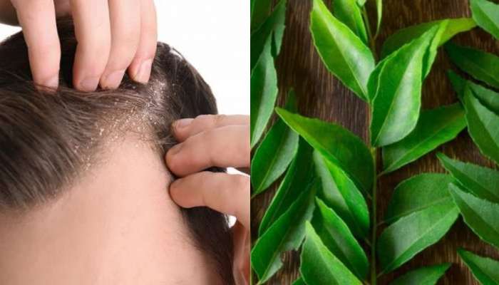 Dandruff: താരൻ കൊണ്ട് ബുദ്ധിമുട്ടുന്നുണ്ടോ? കറിവേപ്പിലയിലുണ്ട് മാജിക്!