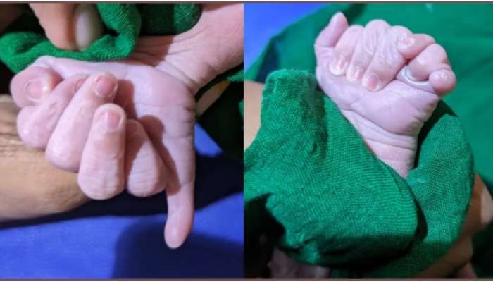 Baby Born with 25 Fingers: കയ്യിലും കാലിലുമായി 25 വിരലുകള്‍; ബെംഗളൂരുവില്‍ ജനിച്ചത് 'അത്ഭുതക്കുഞ്ഞ്' 