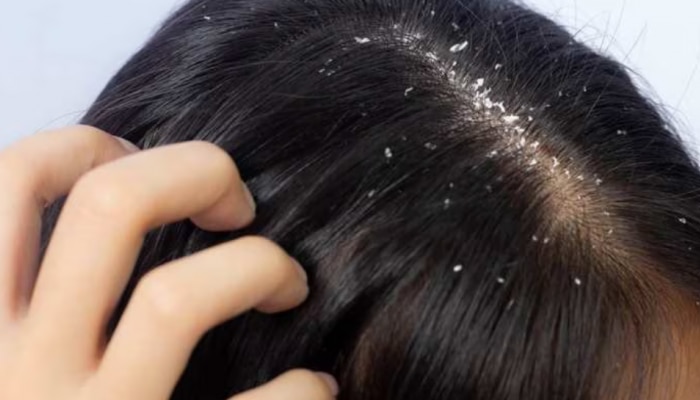  Dandruff: താരനെ അകറ്റാൻ ഇത്ര എളുപ്പമോ! വീട്ടിൽ പരീക്ഷിക്കാവുന്ന ചില പൊടികൈകൾ