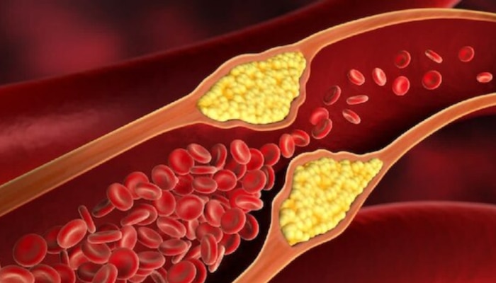 High Cholesterol: കൊളസ്ട്രോൾ കൂടുതലാണോ? ഒഴിവാക്കാം ഈ ഭക്ഷണങ്ങൾ