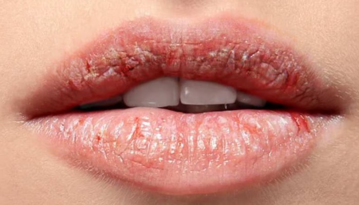 Chapped Lips: ചുണ്ടുകൾ വരണ്ട് പൊട്ടുന്നുണ്ടോ? പരിഹാരം ഇതാ!