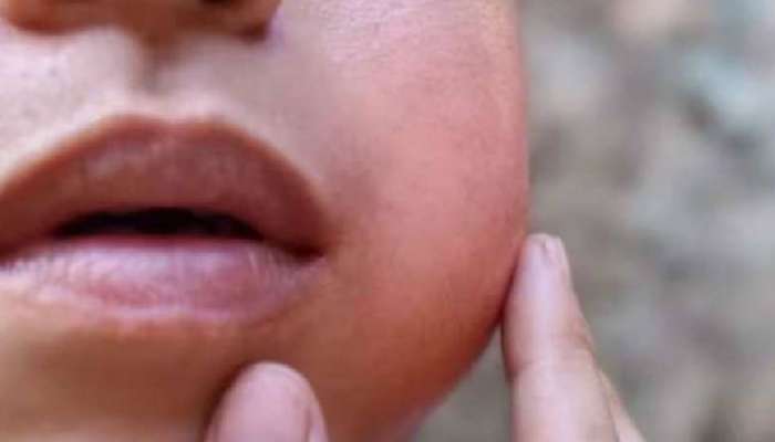 Mumps: അഞ്ച് കുട്ടികൾക്ക് മുണ്ടിനീര്; 21 ദിവസം സ്കൂളിന് അവധി പ്രഖ്യാപിച്ച് ആലപ്പുഴ കളക്ടർ