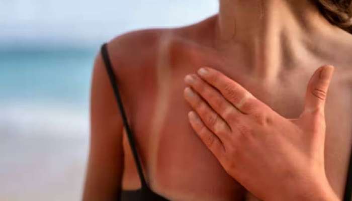 Health Tips: കേരളം ചുട്ടുപൊള്ളുന്നു; സൂര്യാഘാത സാധ്യത തടയാന്‍ ഇക്കാര്യങ്ങള്‍ ശ്രദ്ധിക്കൂ