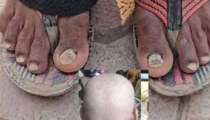Nail loss in Maharashtra: തലയില്‍ ഒരു മുടി പോലും ബാക്കിയില്ല; ഇപ്പോൾ നഖങ്ങളും തനിയെ കൊഴിയുന്നു; ആശങ്കയില്‍ ഒരു ഗ്രാമം