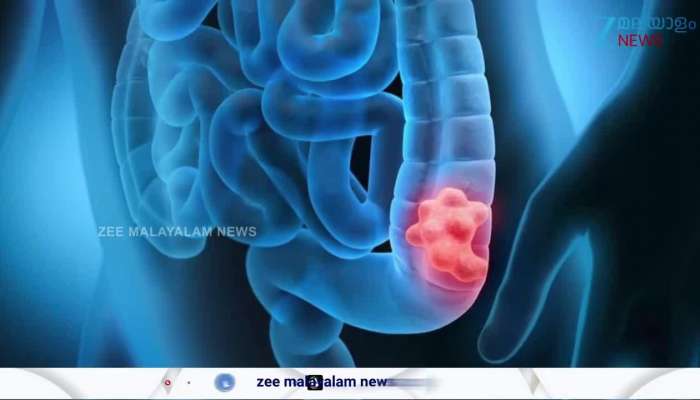 Symptoms of colorectal cancer