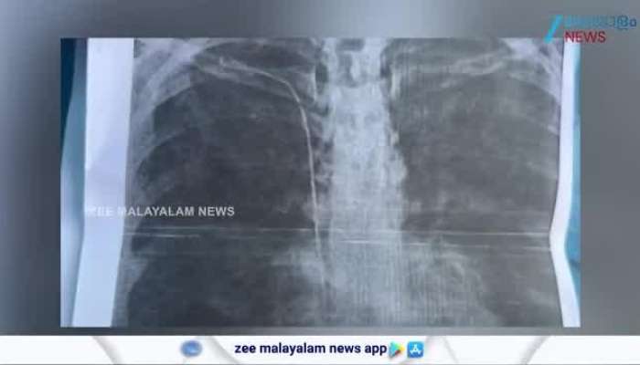 Medical Negligence in Trivandrum General Hospital