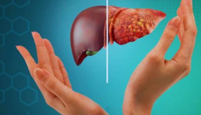 Fatty Liver Symptoms: നിങ്ങൾക്ക് ഫാറ്റി ലിവറുണ്ടോ? തിരച്ചറിയാം ഈ ലക്ഷണങ്ങളിലൂടെ