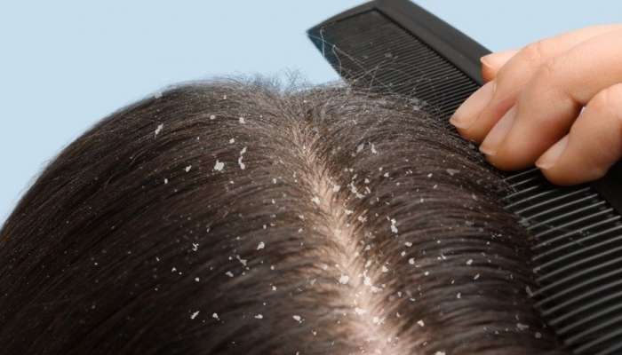 Home remedy for Dandruff:  താരനും ചൊറിച്ചിലും വീട്ടിൽ തന്നെ മാറ്റാം, ഇത്രയും ചെയ്താൽ മതി