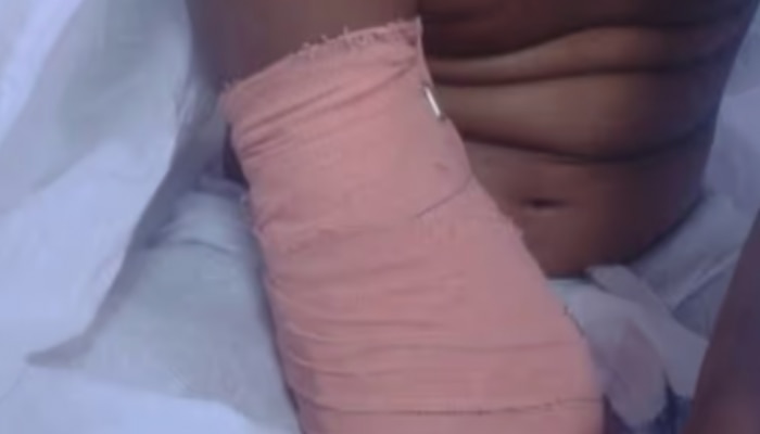 Palakkad News: ഒമ്പതുകാരിയുടെ കൈ മുറിച്ചു മാറ്റിയ സംഭവം; പാലക്കാട്ടെ ഡോക്ടർമാർക്ക് ക്ലീൻ ചിറ്റ് നൽകി അന്വേഷണ റിപ്പോർട്ട്