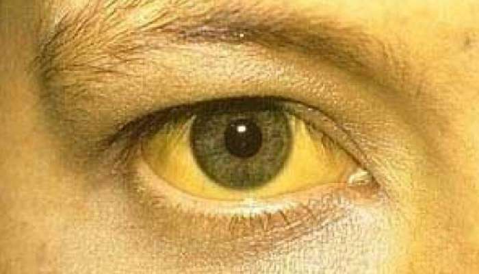 Jaundice: മലപ്പുറത്ത് മഞ്ഞപ്പിത്തം പടരുന്നു; എട്ട് കുട്ടികളുൾപ്പടെ 9 പേര്‍ക്ക്‌ രോഗബാധ