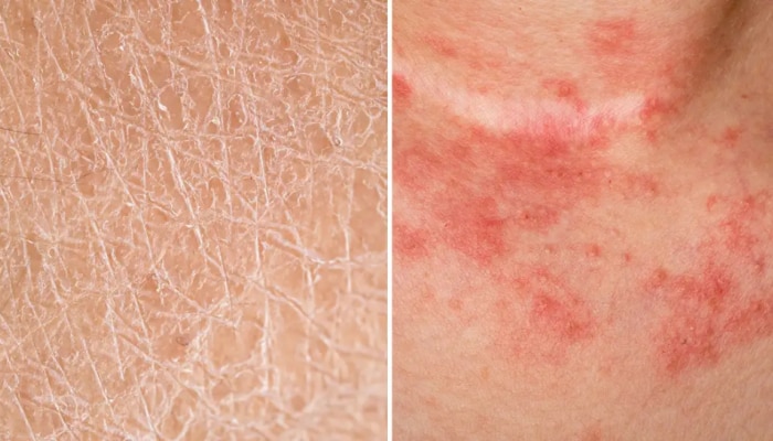Dry Skin vs Eczema: ഒറ്റനോട്ടത്തിൽ ഒരുപോലെ, പക്ഷേ ഒന്നല്ല..! വരണ്ട ചർമ്മവും എക്സിമയും തമ്മിലുള്ള വ്യത്യാസങ്ങൾ...